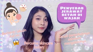 Penyebab wajah berjerawat || Cara mengatasi jerawat membandel..