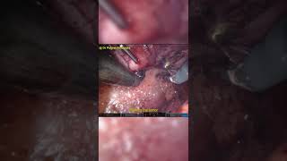 Right Partial Nephrectomy for T2b mass by Dr Puneet Ahluwalia, Uro Oncologist, Max Hospital #Shorts