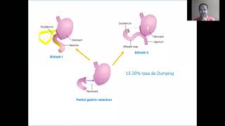 Clase Fisiopatologia y Dietoterapia del Adulto, Sindrome de Dumping