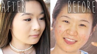 My 7 Month Accutane (Epuris) Experience - Before & After | Eva Chung