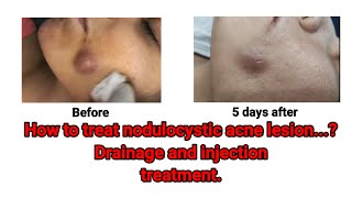 NoduloCystic Acne Treatment: Injection Therapy @DrArifMDDermatologist #NodularAcne #acnetreatment