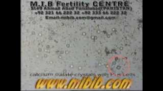 calcium oxalate crystals, with pus cell video