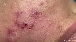 Big Cystic Acne Blackheads Extraction Blackheads & Milia, Whiteheads Removal Pimple Popping