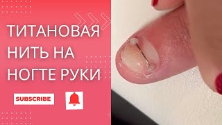 Титановая нить на ногте руки. ЗАЧЕМ? И КАКОЙ БУДЕТ РЕЗУЛЬТАТ?