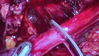 Laparoscopic uretero-ureteroanastomosis after ureteral  resection for invasing colon cancer