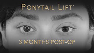 Ponytail Lift | Facelift Before And After Video | How About Those Eyebrows?