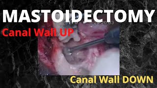 068. Canal Wall UP & Canal Wall DOWN Mastoidectomy  #mastoid surgery #hearingimpaired