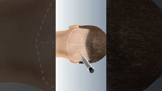 FUE Hair Transplant.    Have you had any experience with this procedure?