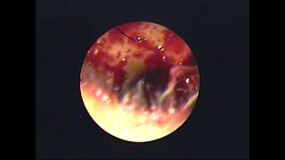 Endoscopic TM fascia Tympanoplasty two handed(unedited)-dr.shreekantha acharya