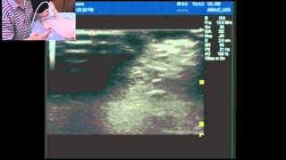 Ultrasound guided ankle block part 2: Sup/deep peroneal(fibular) nerves and saphenous nerve