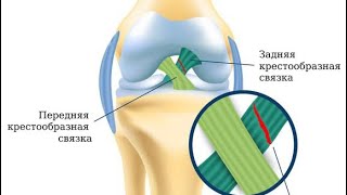 Разрыв задний крестообразной связки. Реабилитация колена.