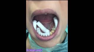 how to fit dental crowns in patients mouth