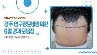 광주 압구정모비앙의원 6월 경과 모음집 #광주탈모치료 #전남모발이식