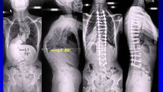 Surgery for neglected/revision cases in adolescent idiopathic scoliosis