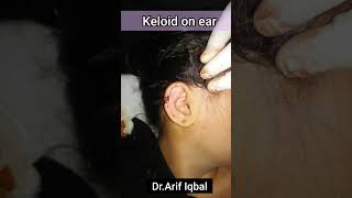 Ear keloid surgery #Ear #keloid #shorts #youtubeshorts