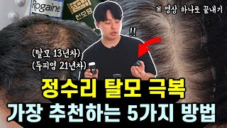 정수리 탈모, 가르마 탈모 치료에 추천하는 가장 효과적인 방법 5가지 (feat. 천모담 어성초 흑채)