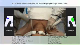 High Speed LightSheer Duet vs. 810nm Legs and Armpits Treatment