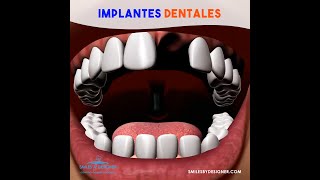 ✅ Implantes Dentales en Lima Perú 🔴 Paso a Paso