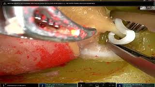 Retzius-Sparing Radical Prostatectomy Posterior Approach  -  Simulation Model