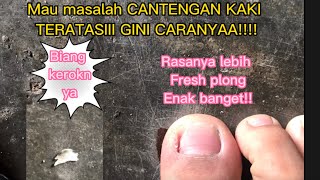 Cara mengatasi cantengan jempol kaki? Gini caranya