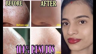 *3 EASY STEP * NATURALLY REMOVES BLACK HEAD & WHITE HEAD AT HOME / SUMMER SKINCARE  / PINKISVENTURE