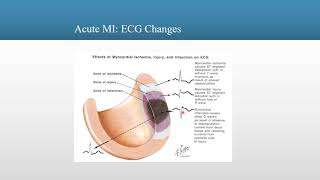 12_Lead EKG : Understanding Ischemia, Injury and Infarctions