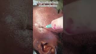 Prick #needle #health #medicaleducation#bds#dds#omfs #oraldiagnosis#viral#tutorial#pain #lifesaving