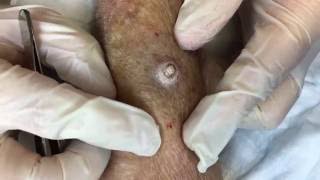 Surgical Excision of Keratoacanthoma