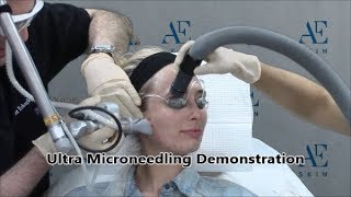 Ultra Microneedling Demonstration 21 Andrea Hunt - A E Skin - Encino, CA - 818-835-1833