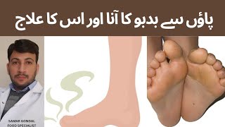 Reasons for smelly feet & its treatment |  پاؤں سے بدبو کا آنا اور اس کا علاج