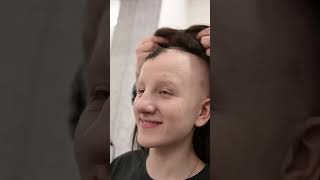 Anička alopecie