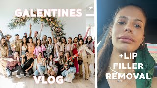 Galentines Event + Getting my Lip Filler Dissolved VLOG!