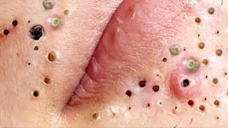 Big Cystic Acne Whiteheads Extraction Blackheads & Milia, Whiteheads Removal Pimple Popping #2