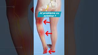 Ai probleme cu sciatica ? #sciatica