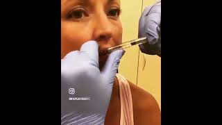 Lip Filler Timelapse at Darren Smith MD