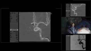 Embolización endovascular de 2 aneurismas con coils