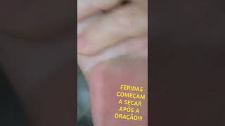 INCRÍVEL: FERIDAS COMEÇAM A SECAR!!!