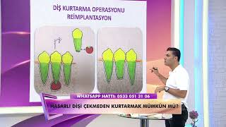 Kanal Tedavisinde başarısız olunmuş dişlerde, iltihab oluşursa Diş Çekmeden Kurtarılabilir mi?