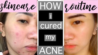 HOW TO GET  RID OF ACNE AND SCARS FAST | Updated skincare routine