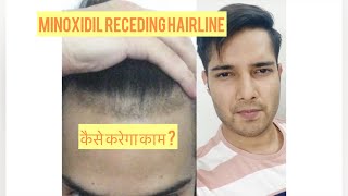 Does MINOXIDIL work for Receding Hairline?Minoxidil Finasteride Results|कैसकरे| Hair regrowth| Hindi