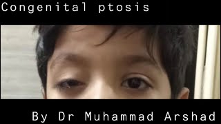 Treatment of Ptosis (dropping eyelid)