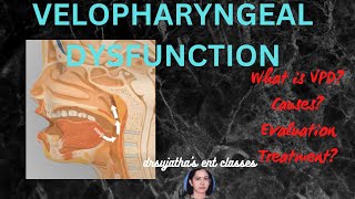 202.Velopharyngeal dysfunction Lecture #VPI #VPD #swallowing #voice