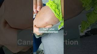 تشكيل كانيولا Cannula insertion #احمد_الخاتوني