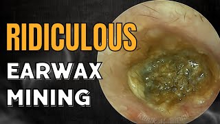 RIDICULOUS Earwax Mining Technique