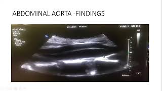 Abdominal Aortic Dissection - Case Report