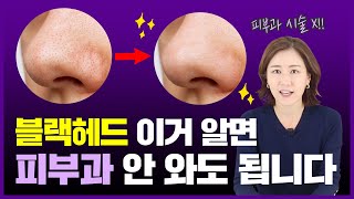 피부과 시술 없이 블랙헤드 제거하는 홈케어 방법