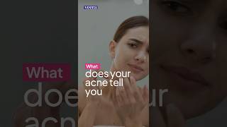 What does your acne tell you #acne #skincare