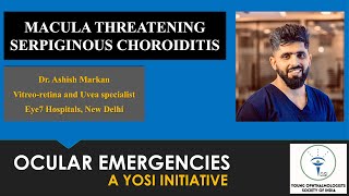 Macula Threatening Serpiginous Choroiditis | Dr Ashish Markan | YOSI Ocular Emergency | Episode 19