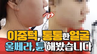 울쎄라+튠페이스로 이중턱 시원하게 정리하기