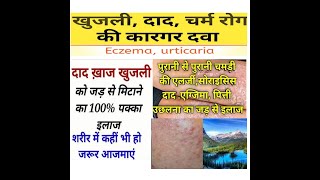 Skin Diseases Best Homoeopathic Medicine/Eczema, Psoriasis, Ringworm,  Urticaria , Itching//HM4U Rke